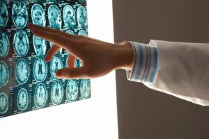 What Are Common Brain Injury Symptoms After an Accident in Missouri & Kansas?